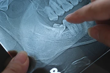 Врач назвал возраст, до которого нужно успеть прощаться с «восьмерками»